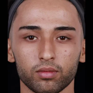 Before after rhinoplasty image by Dr. Armin Akbari
