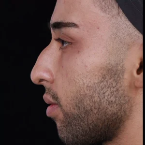 Before after rhinoplasty image by Dr. Armin Akbari