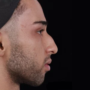 Before after rhinoplasty image by Dr. Armin Akbari