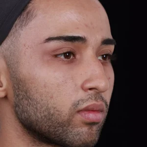 Before after rhinoplasty image by Dr. Armin Akbari