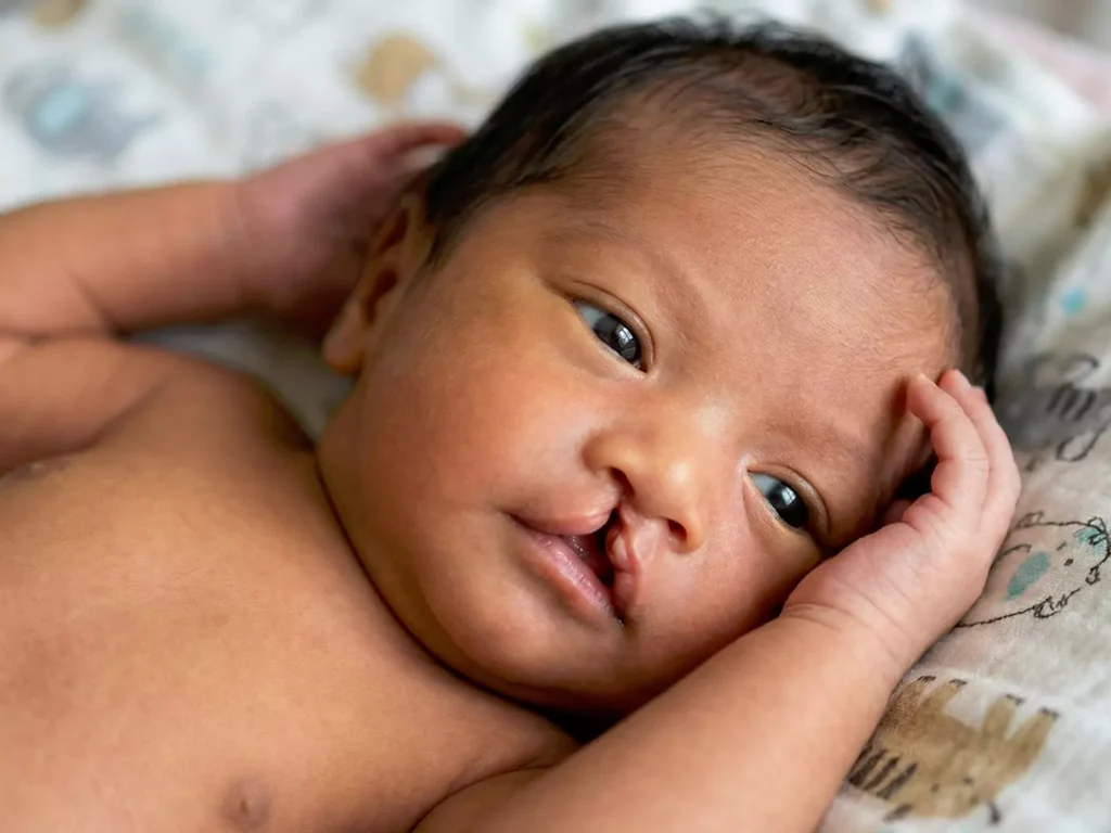  cleft lip and palate prevention during prenancy