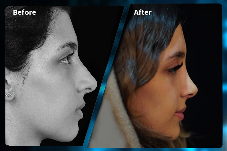 نمونه کار جراحی بینی دکتر آرمین اکبری