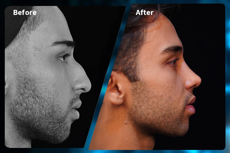 نمونه کار جراحی بینی دکتر آرمین اکبری